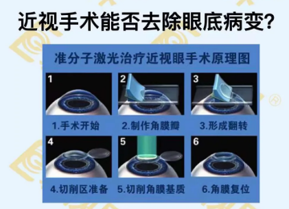 近視手術(shù)能否去除眼底病變？