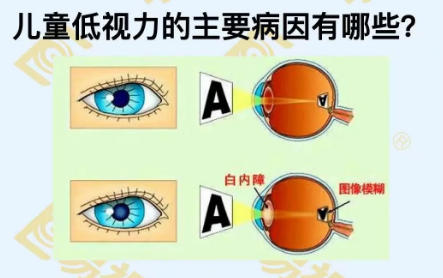 兒童低視力主要病因有哪些？