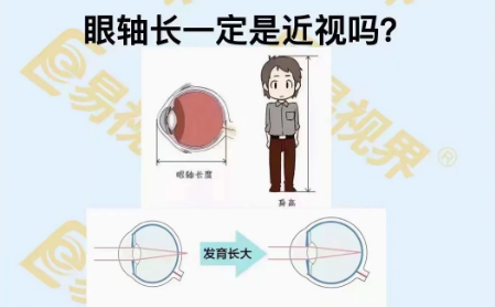 眼軸長(zhǎng)一定是近視嗎？