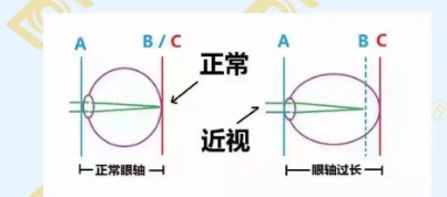 哪個年齡近視度數(shù)最容易增長？