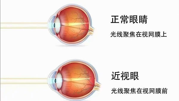 低濃度阿托品的注意事項